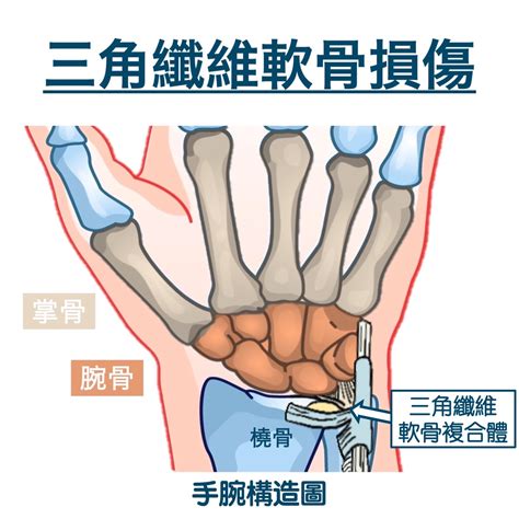 手受傷|三角纖維軟骨（tfcc）受傷怎麼治療？手腕軟骨受傷多久會好？ ∣